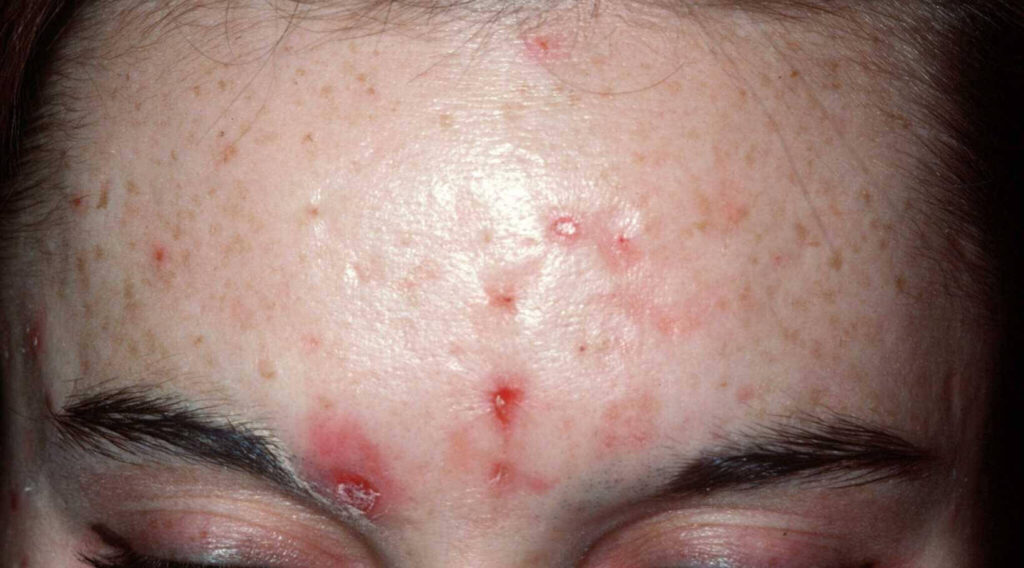 voorbeeld van krab acne